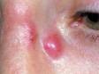 An abscess usually starts as a tender or painful, red and swollen area.