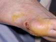 Due to an injury to the foot, an abscess formed and was then drained by the emergency doctor.