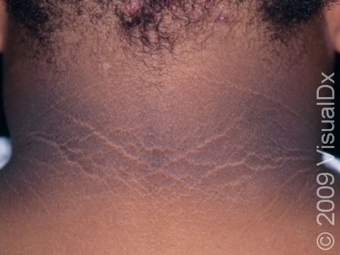Acanthosis nigricans ที่คอ