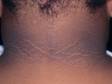 The neck displays the skin thickening and dark color of acanthosis nigricans.