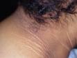 The thickening on the skin of the neck from acanthosis nigricans often has a "furrowed" appearance.