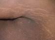 In addition to the subtle darkening and thickening of the armpit skin caused by acanthosis nigricans, striae (stretch marks) can be seen.