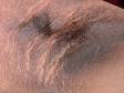 In this image of acanthosis nigricans, the patient has very pronounced skin thickening such that the folds appear to have deep cracks and a noticeable texture in comparison to the surrounding skin.