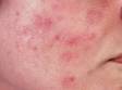 This image displays redness without active acne lesions from rubbing and picking at acne.