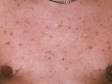 Scars displayed as dark spots (hyperpigmentation) with virtually no active acne on chest are a sign that the patient is picking and squeezing the lesions.
