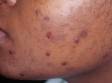 This image displays the result of squeezing and picking at acne on people with darker skin.