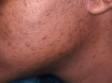 This image displays flat, brown blemishes, a result of acne inflammation of the skin in a Black patient.