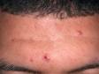 The bloody crust on the center acne lesion is a sign that it has been manipulated.