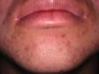 This image displays dark spots and scars, a consequence of manipulating acne lesions.
