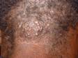 The lesions of acne keloidalis nuchae can be focused in a limited area at the back of the neck or scalp, as displayed in this image.