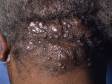 The back of the scalp and neck is the typical location for acne keloidalis.
