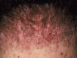 Numerous smooth, scar-like, small, raised lesions at the back of the neck are typical of acne keloidalis nuchae.