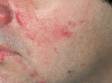 This image displays several large, inflamed bumps typical of acne vulgaris.