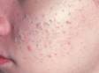 Blackheads (open comedones) are follicles plugged with scale and oil, as displayed in this image.