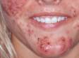 This image displays severe cystic acne.