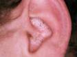 This image displays blackheads (open comedones) in the ear area typical of acne.