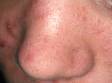 Multiple "blackheads" (open comedones) as well as a few red, inflammatory bumps are seen here on the nose.