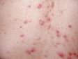 Close-up of pustules and inflammatory skin lesions of acne.