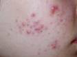 This image displays small bumps, pus-filled lesions, and residual flat, red marks typical of acne.
