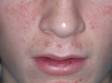 This image displays numerous pink bumps and pus-filled lesions typical of acne.
