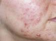 As displayed in this image, moderate and severe inflammatory acne can leave depressed scars.