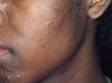 This image displays small bumps and pus-filled lesions, as well as dark, flat marks, typical of acne.