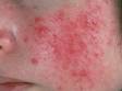 This image displays the overall redness of the cheeks with accompanying red bumps typical of inflammatory acne.