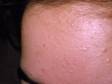 Whiteheads (closed comedones) are the earliest lesions of acne.