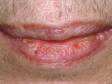 This image displays thick, scaly skin around the lips, typical of actinic cheilitis, due to sun damage.