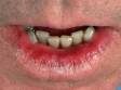 This image displays scaly, dry, cracked lips due to actinic cheilitis.