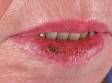 Lips affected by actinic cheilitis can appear scaly or crusty until treated.