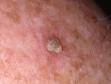 This image displays an actinic keratosis with brown spots suggesting chronic sun damage.