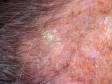 This image displays a thin white scale typical of actinic keratosis.