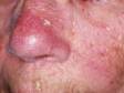 This image displays multiple actinic keratoses on the face.