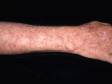 The forearm is a very common area for sun damage and actinic keratoses.