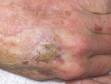 This image displays a large actinic keratosis with a yellowish crust.