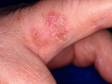 This image displays an actinic keratosis in an unusual location, the side of the finger.