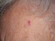 While the rough, gritty scale of actinic keratoses is sometimes easier to feel than see, it can also be very obvious to the naked eye as with this lesion on the forehead.