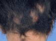 This image displays a patient with alopecia areata that has had some spontaneous regrowth, covering many of the areas of hair loss.