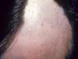 This image displays broken hairs in hair follicles with an otherwise smooth scalp caused by alopecia areata.