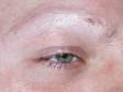 Alopecia Areata can effect the eyebrows as well as any other hair growth areas.
