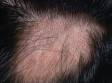 This image displays a close-up of the scalp with a round area of non-scarring hair loss typical of alopecia areata.