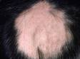 This image displays a circular area of hair loss, with no redness or scarring of the scalp, typical of alopecia areata.