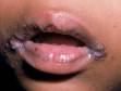 This image displays a frequent location for candida infection (angular cheilitis), the corners of the mouth.