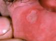 This image display the grayish-white color of an aphthous ulcer.