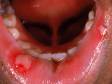 This canker sore (aphthous ulcer) has a typical red border and white center.