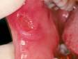 As displayed in this image, aphthous ulcers can be large, deep, and painful.