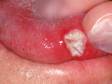 As displayed in this image, aphthous ulcers typically have a white or yellow color.