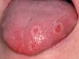 This image displays a tongue with three small ulcers from aphthae.