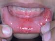 This image displays an unusually large amount of canker sores of the lower inner lip.